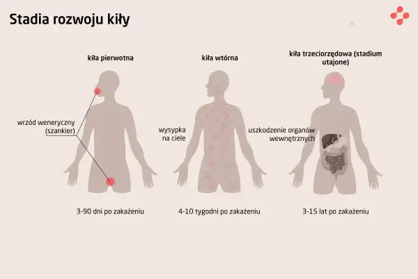 Kiła - jak ją rozpoznać, zbadać i skutecznie leczyć